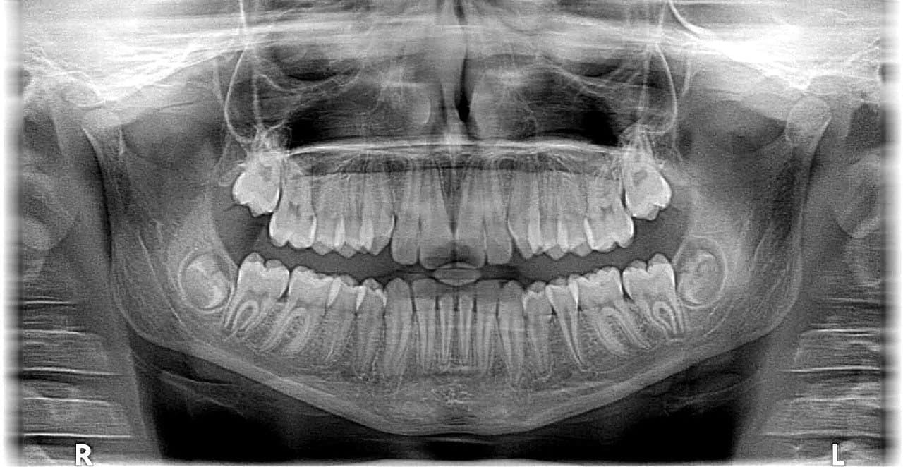 Dental X-Ray