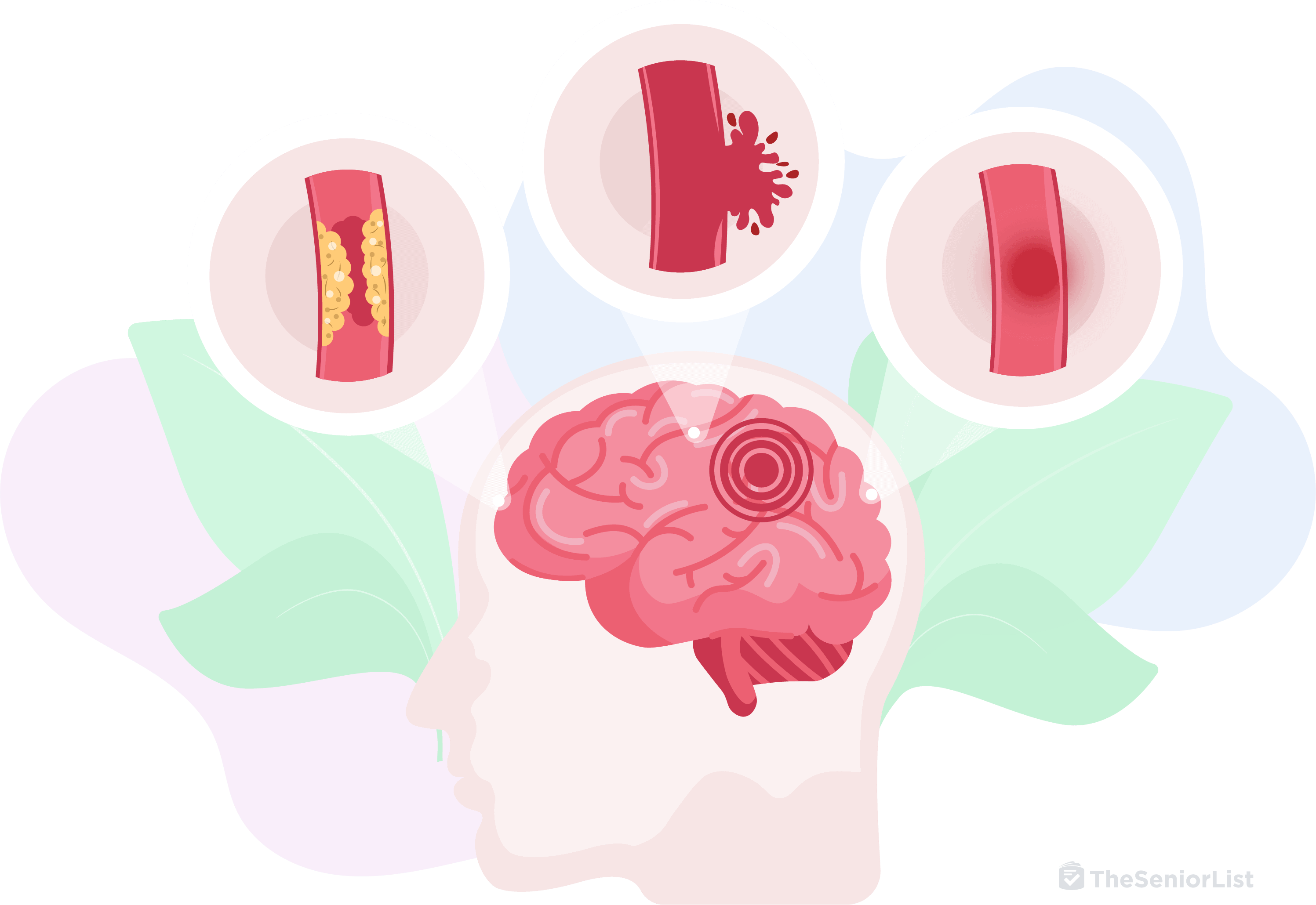 Image of a person's brain and what happens during a stroke.